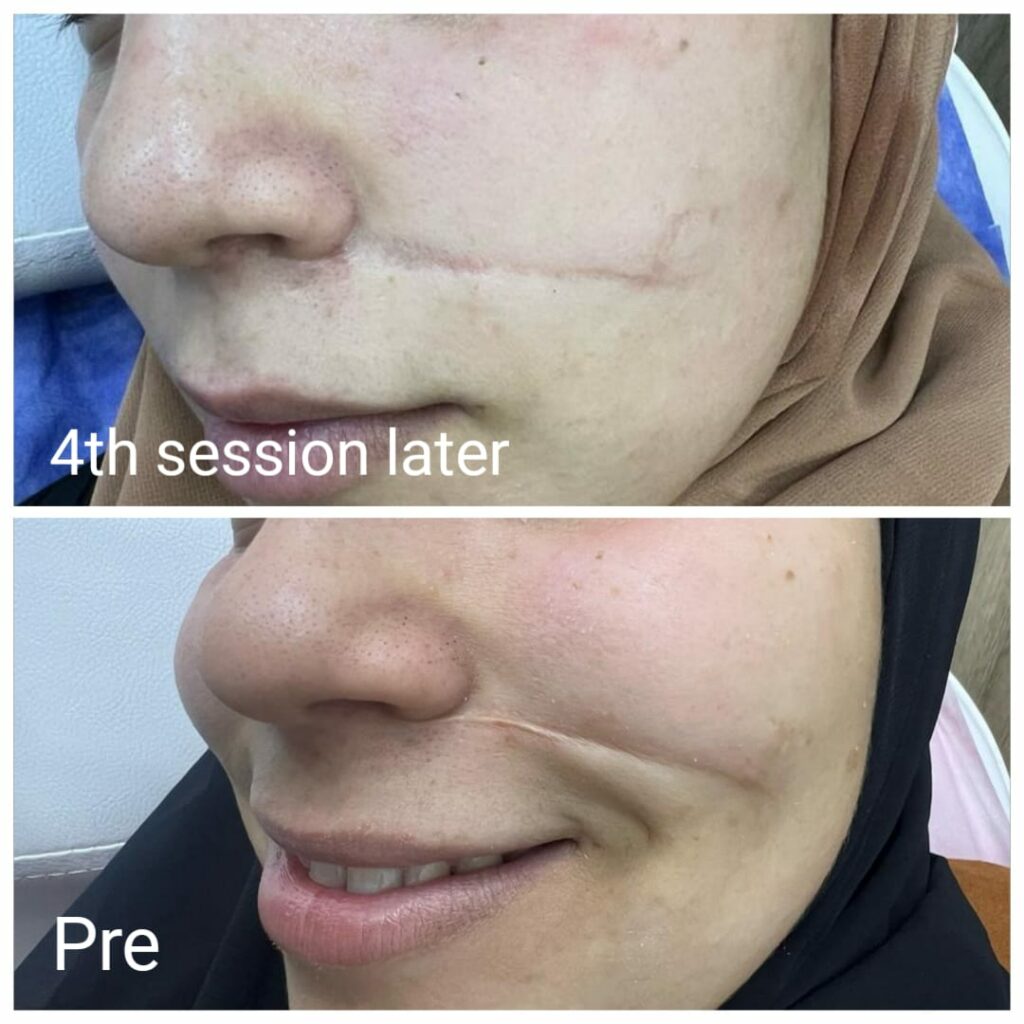 ازالة ندب الوجه والنتيجة بعد 4 جلسات